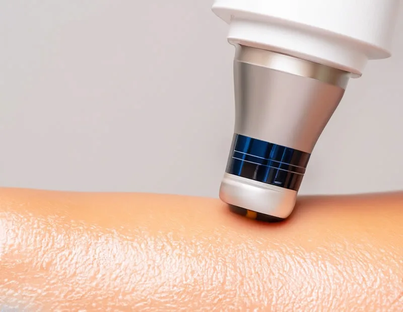 Evaluation of the J-Plasma Electrosurgical Device Combined with Nebulized Collagen for Burn Healing in Rodents